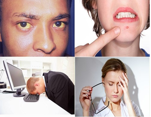 Dấu hiệu của bệnh gan nhiễm mỡ