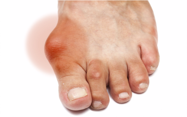 Biểu hiện điển hình của gout là sưng các khớp ngón chân, ngón tay.