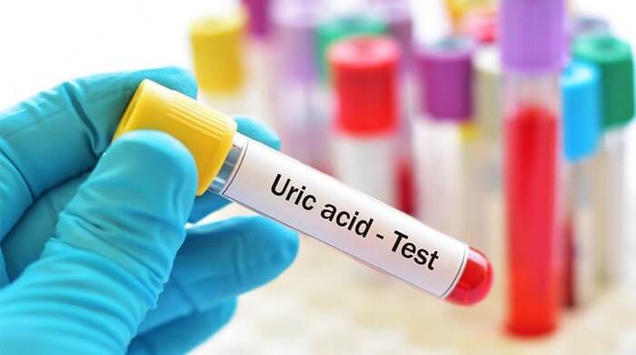 Acid Uric cao là nguyên nhân chính gây nên bệnh Gout