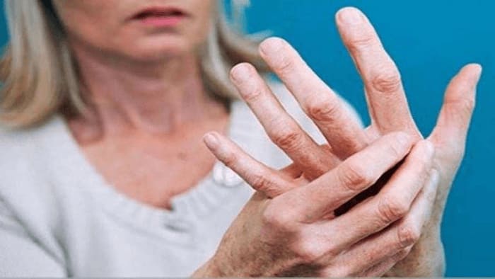 Bệnh phong thấp và những điều cần biết