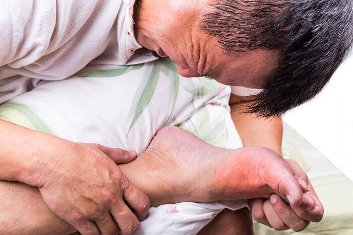 Đau và sưng khớp ngón chân là triệu chứng của bệnh gout