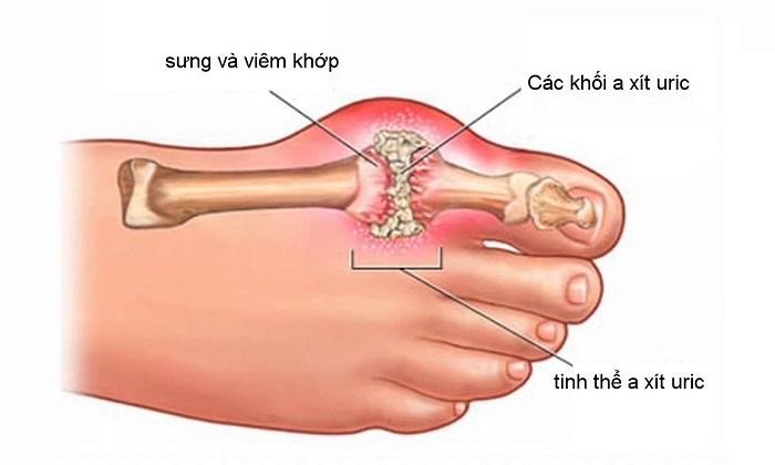 Số người mắc bệnh Gout đang ngày càng gia tăng và dần trẻ hóa.