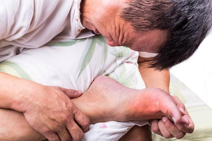 Gout được biết đến là căn bệnh do rối loạn chuyển hóa các chất dinh dưỡng trong cơ thể, làm tăng acid uric trong máu.