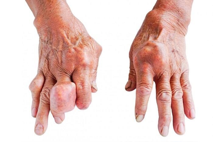Bệnh Gout gây biến dạng tứ chi, ảnh hưởng lớn đến đời sống của người bệnh