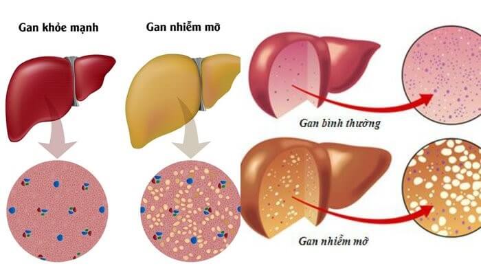 Sự khác biệt giữa gan bình thường và gan nhiễm mỡ