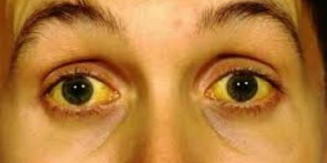 Tình trạng vàng da và niêm mạc mắt