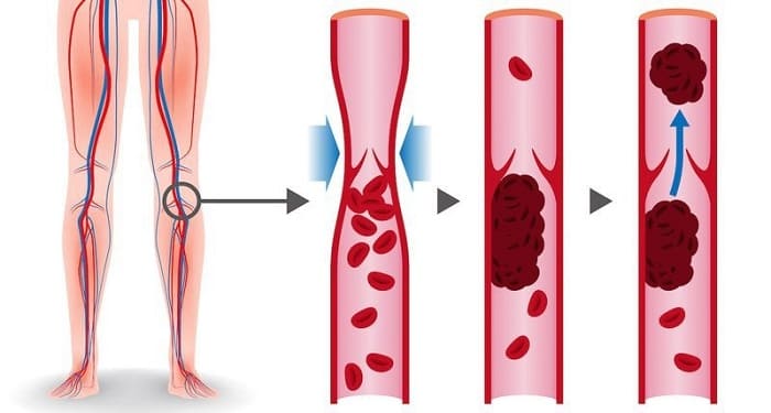 Cục máu đông hình thành trong tĩnh mạch bị suy giãn