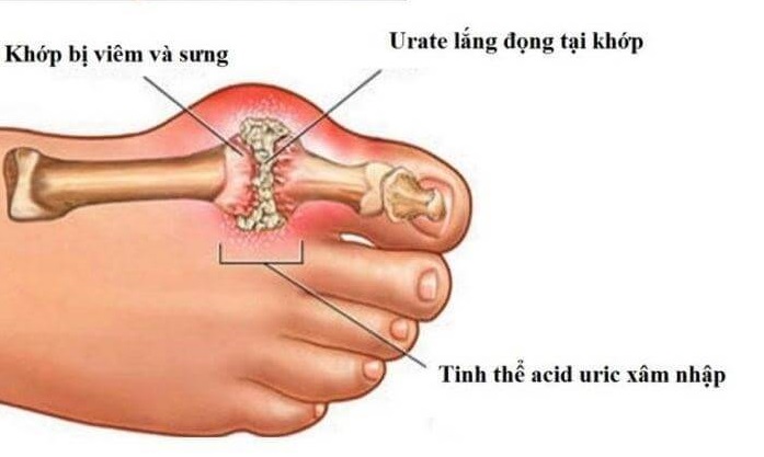 Các khớp sưng đau do tích tụ  các tinh thể acid uric là một trong biểu hiện của bệnh gout
