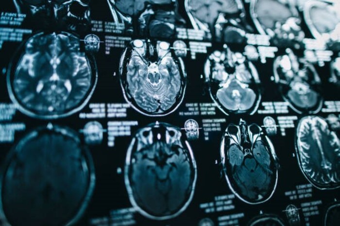 Thực hiện các chẩn đoán hình ảnh giúp đánh giá các tổn thương não