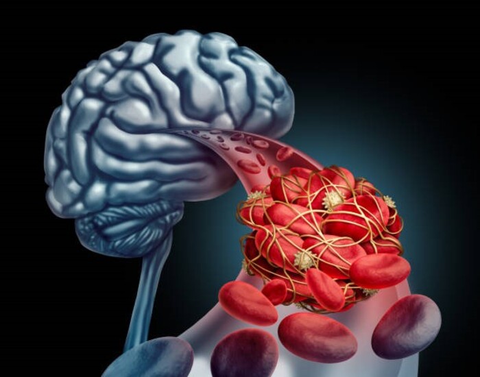 Sự lưu thông máu não có thể bị rối loạn bởi cục máu đông