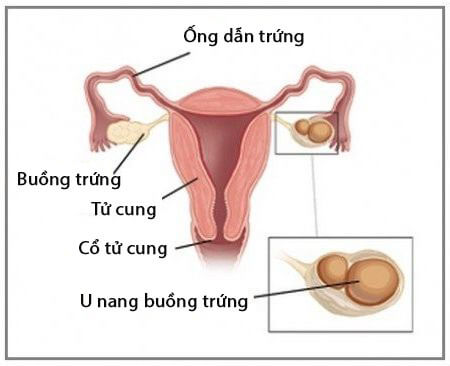 U nang buồng trứng là gì nguyên nhân triệu chứng cách điều trị và cách phòng ngừa bệnh hiệu quả