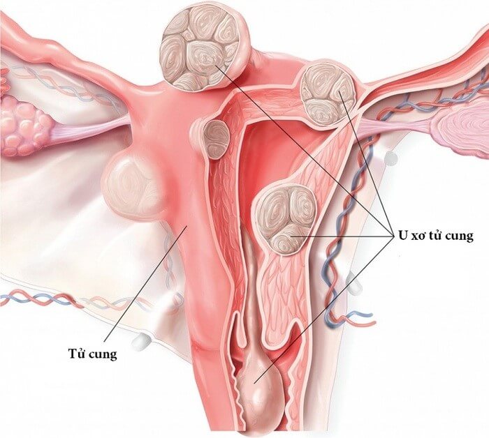 U xơ là các khối u lành tính của các sợi cơ trơn tử cung