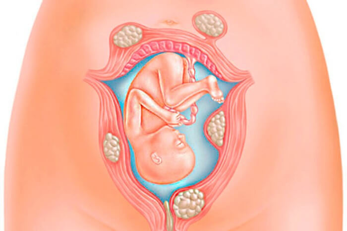 U xơ tử cung khi mang thai ảnh hưởng tới sức khỏe thai nhi