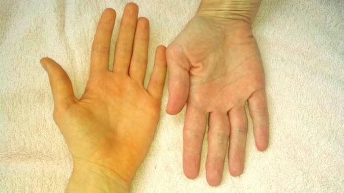 Vàng da là dấu hiệu cho thấy bạn bị suy giảm chức năng gan