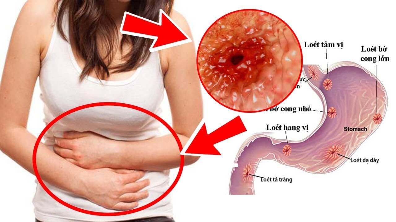 Viêm loét dạ dày sẽ gây ra các cơn đau ảnh hưởng rất nhiều đến cuộc sống.