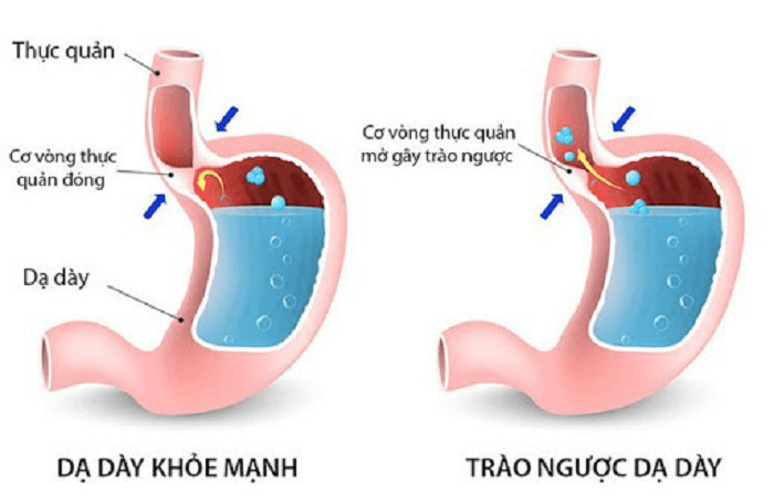 Bệnh trào ngược dạ dày là gì?