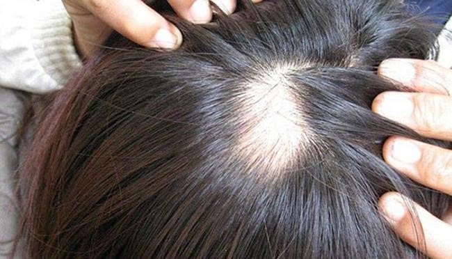 Rụng tóc từng mảng Nguyên nhân dấu hiệu chẩn đoán và cách trị