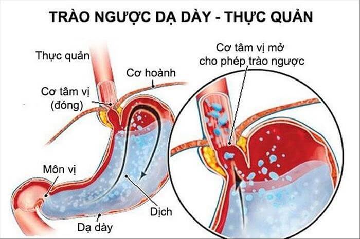 Thế nào là trào ngược dạ dày thực quản