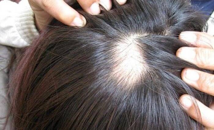 Tóc rụng từng mảng gây kém thẩm mỹ và làm mất sự tự tin khi giao tiếp - serum mọc tóc