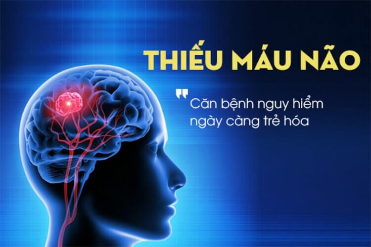 Thiếu máu não căn bệnh nguy hiểm ngày càng trẻ hóa