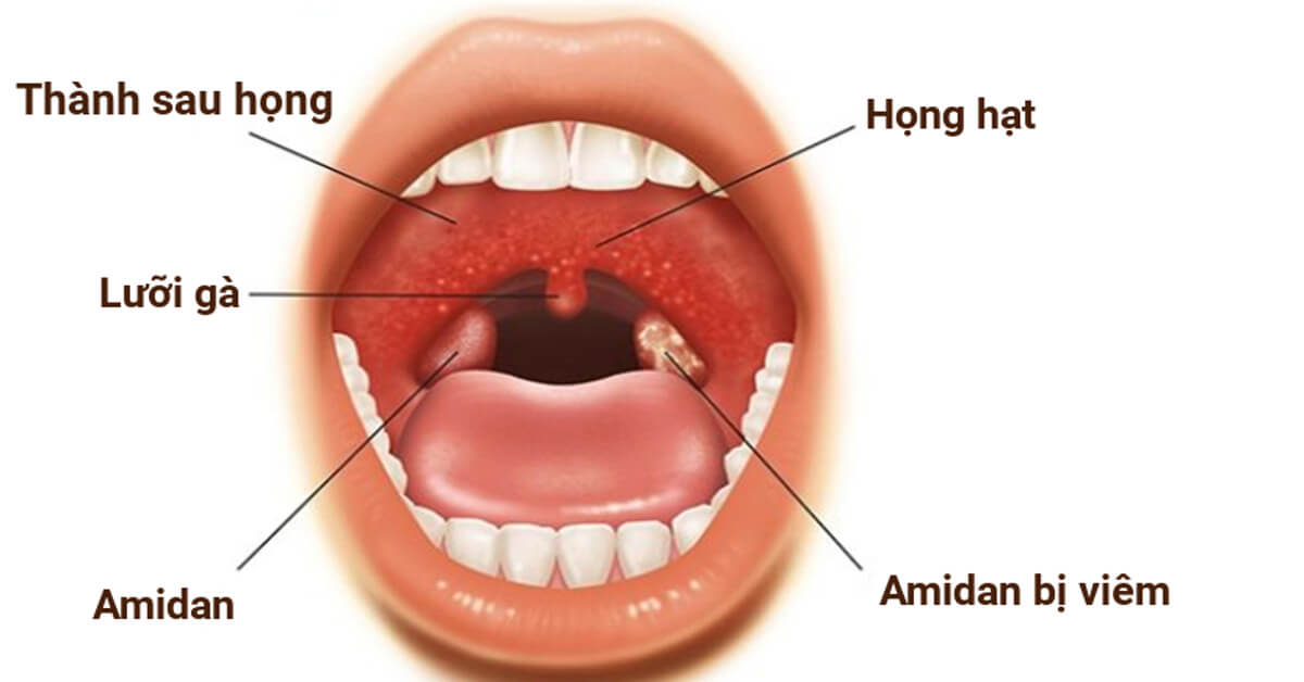 Các cách trị đau họng an toàn hiệu quả tại nhà