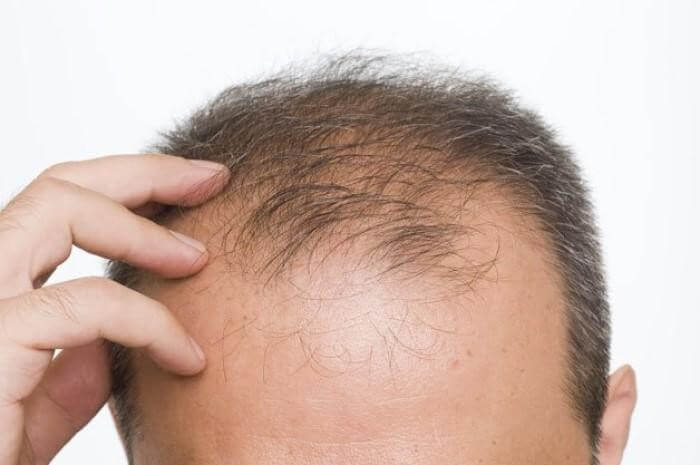 Sử dụng các loại thuốc giúp kích thích mọc tóc và giảm rụng tóc ở nam giới