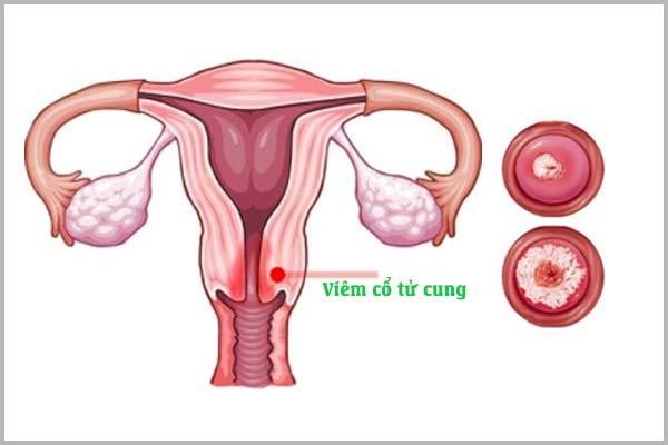 Tình trạng viêm cổ tử cung ở nữ giới