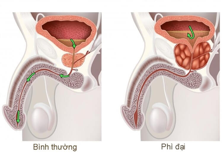 Tuyến tiền liệt có thể tăng thể tích lên gấp nhiều lần so với bình thường