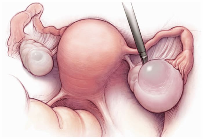 U nang buồng trứng – bệnh phụ khoa phổ biến ở nữ giới