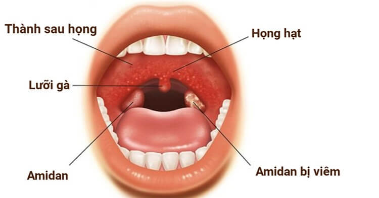 Viêm họng hạt xảy ra do hệ miễn dịch không chống chọi được với vi khuẩn