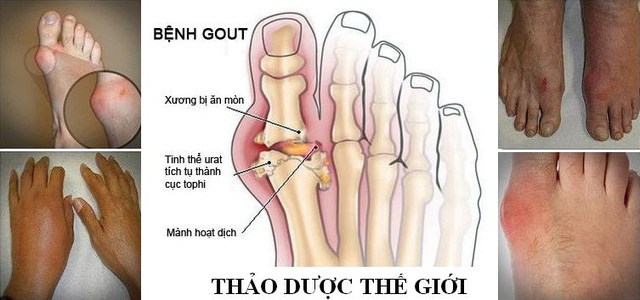 Các biểu hiện của bệnh gout thường gặp