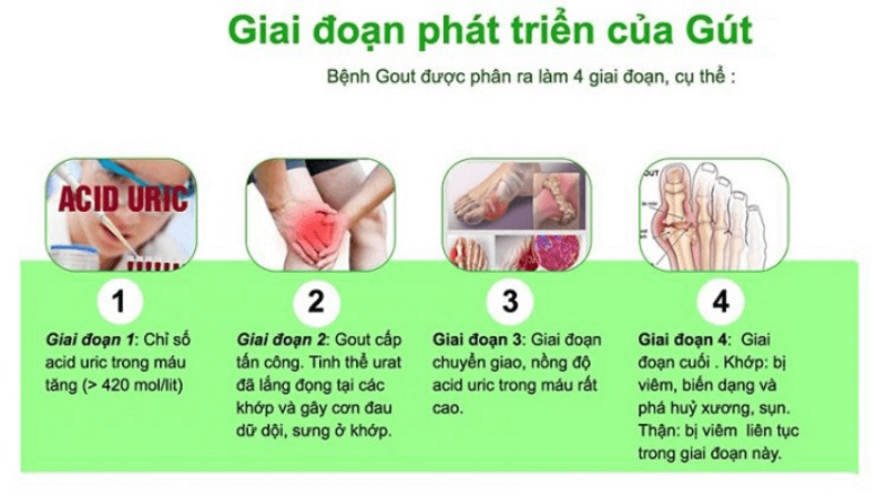 Các giai đoạn phát triển của bệnh gout