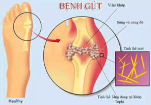 Cách điều trị bệnh gout an toàn và hiệu quả