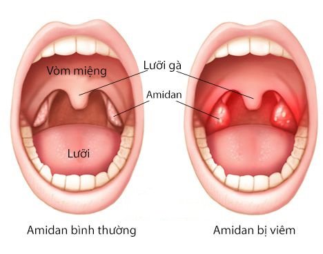 Hình so sánh giữa amidan bình thường và amidan bị viêm