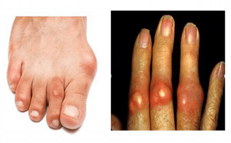 Biểu hiện tay và chân của người bị bệnh gout