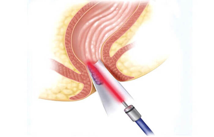 Phương pháp cắt trĩ bằng Laser