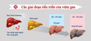 Tùy vào tình trạng của gan mà sẽ có những biểu hiện khác nhau