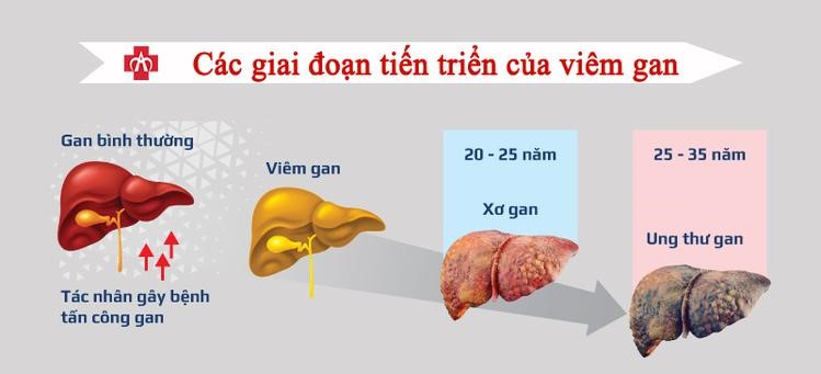 Tùy vào tình trạng của gan mà sẽ có những biểu hiện khác nhau