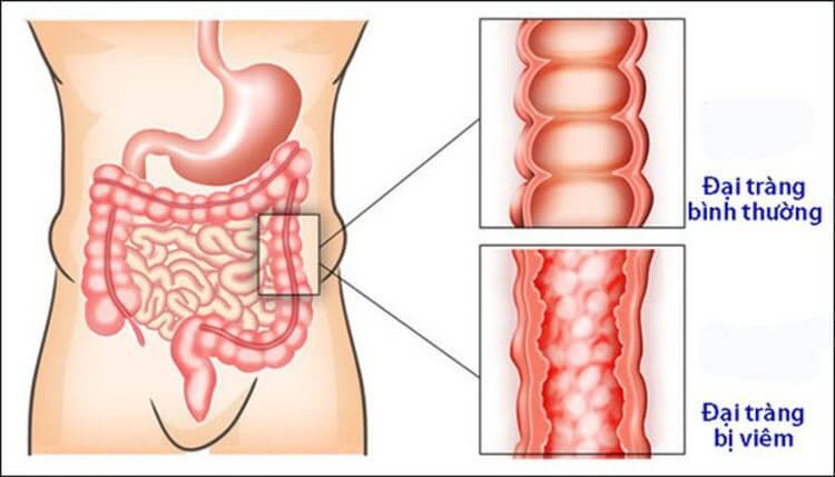 Viêm đại tràng là tình trạng niêm mạc đại tràng của cơ thể người bị viêm nhiễm