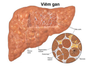 Viêm gan là gì? có mấy loại viêm gan mạn tính và cấp tính