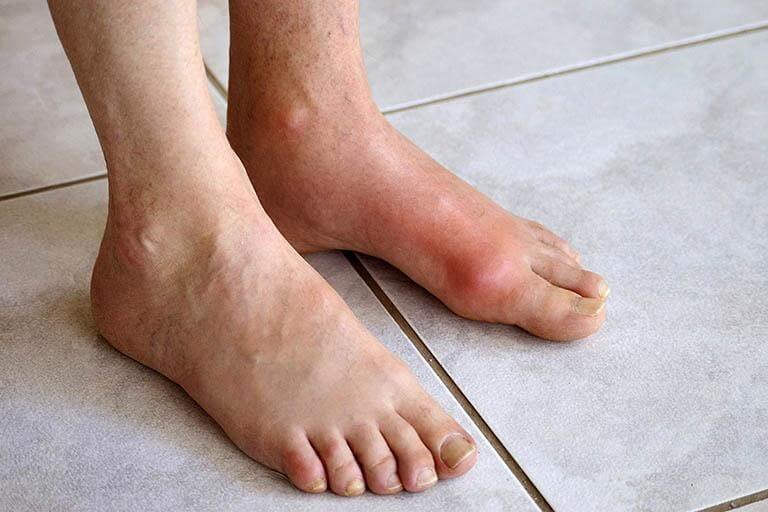 Bệnh Gout là bệnh phổ biến hiện nay