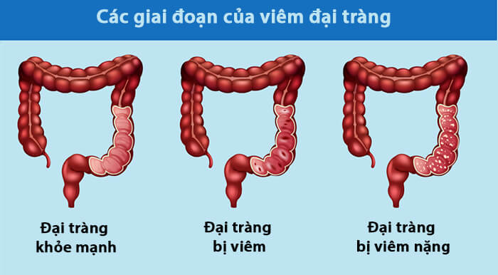 Các giai đoạn của bệnh viêm đại tràng