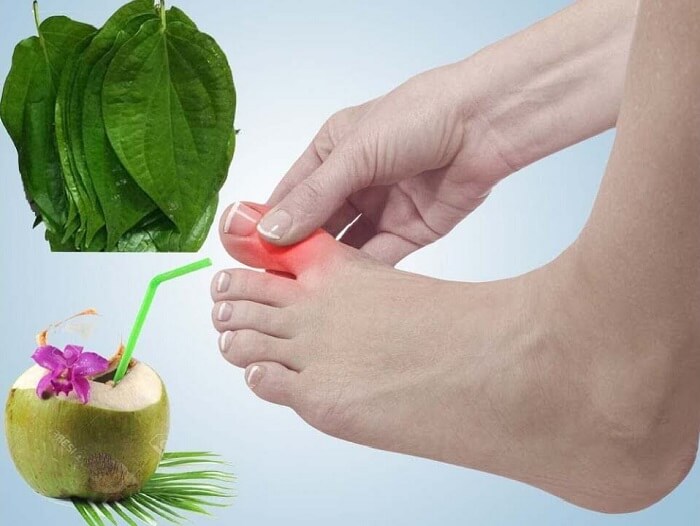 Trị bệnh gout bằng lá trầu không và nước dừa cần phải kiên trì