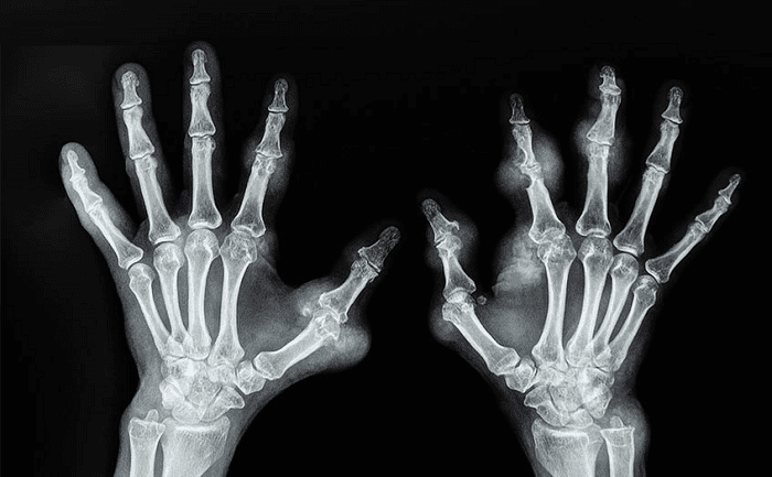 Một hình ảnh cho thấy bệnh nhân bị hạt tophi ở ngón tay