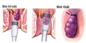 Phương pháp điều trị bệnh trĩ bằng vòng cao su