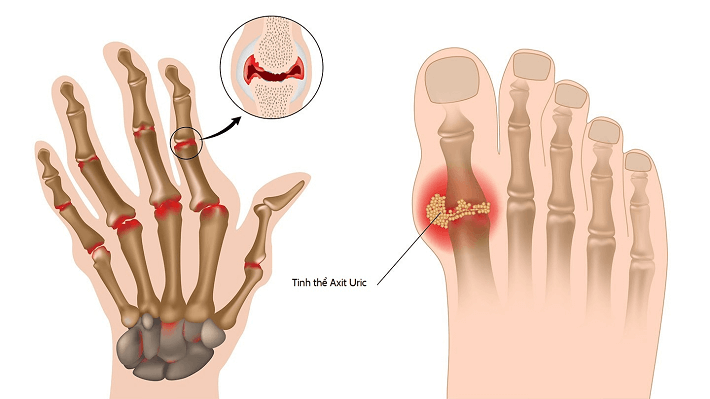 Tinh thể Axit Uric đọng lại ở các khớp gây nên bệnh Gout