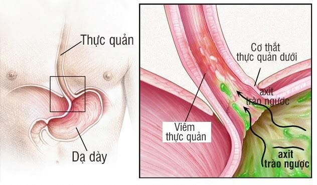 Viêm thực quản có thể là nguyên nhân dẫn đến đau thượng vị