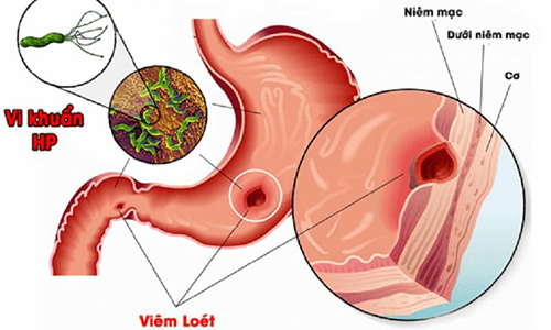 Là loại virus phổ biến về bệnh lý dạ dày - gây viêm loét dạ dày