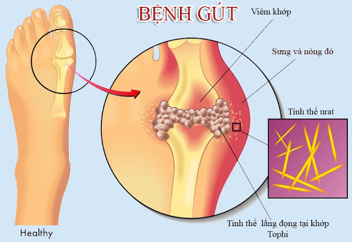 Tăng acid uric máu làm hình thành nên bệnh gout