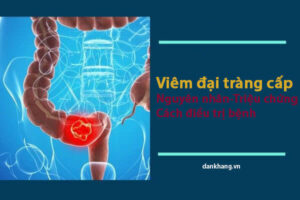 Viêm đại tràng cấp là gì? Nguyên nhân triệu chứng và cách điều trị bệnh hiệu quả